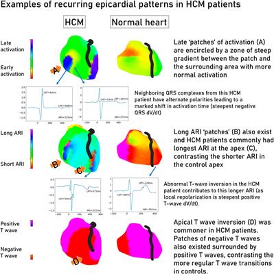 The arrhythmic substrate of hypertrophic cardiomyopathy using ECG imaging